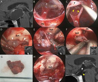 Reinvestigating Tumor–Ventricle Relationship of Craniopharyngiomas With Predominantly Ventricular Involvement: An Endoscopic Endonasal Series Based on Histopathological Assessment